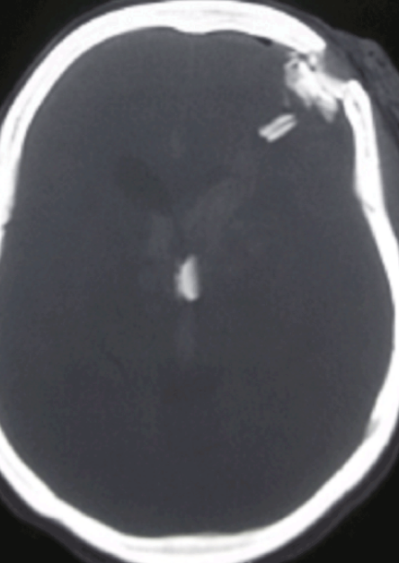 Computed Tomography Of Non-Missile Penetrating Head Injury. This image shows a
break in the left frontal cranium and dura mater. A fragment of the weapon has
penetrated the brain. Edema in the area collapses the left lateral ventricle.