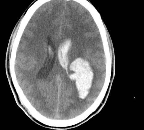 Head CT, Intraventricular and Intraparenchymal Hemorrhage From Arteriovenous Malformations (AVM)