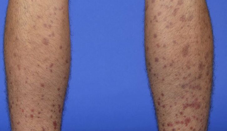 IgA Vasculitis (Henoch-Schönlein Purpura)
