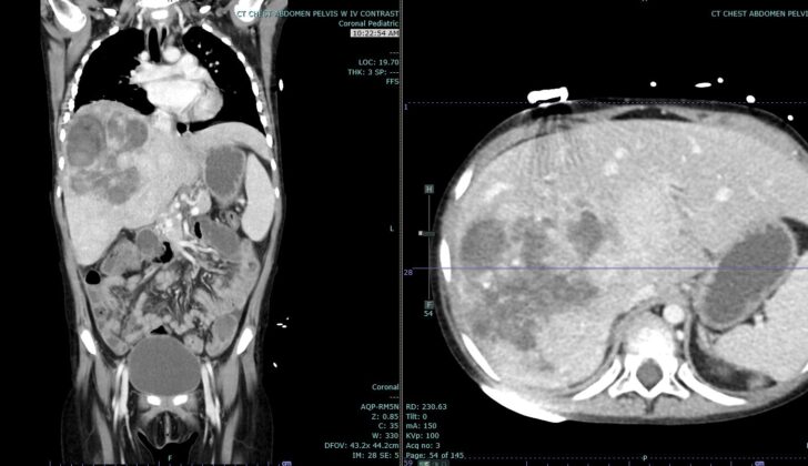 Hepatoblastoma