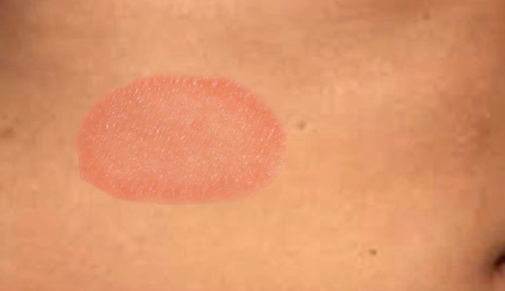 Herald Patch. A herald patch presents as a circular or oval-shaped erythematous patch with central clearing and trailing peripheral scales measuring 2 to 10 cm.