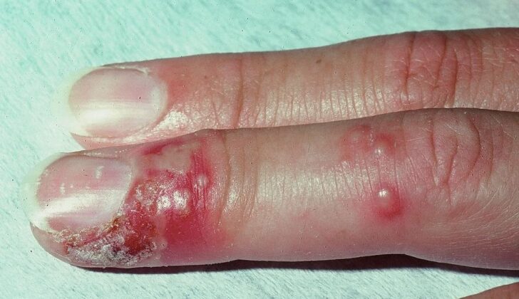 Herpetic Whitlow