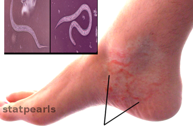 Hookworm infection