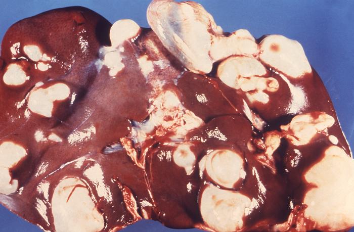 Sheep's Liver, Cysts, Hepatic echinococcosis due to tapeworm, Echinococcus
granulosus, Pathology, Parasitology
