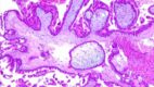 Hydatiform Mole. Chorionic villi with hydropic change, formation of cystic spaces and exuberant villous trophoblastic hyperplasia.