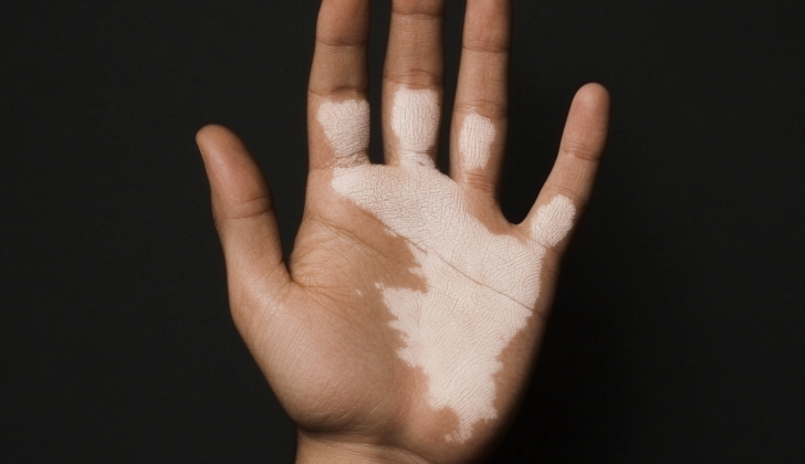 Hand that has patch of skin with less melanin pigment