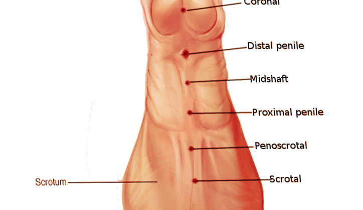 Location of hypospadias
