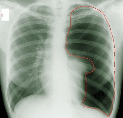 Left Pneumothorax on X-ray. This chest x-ray shows the disappearance of lung
markings in the left pleural cavity (area marked with a red line), indicating
the presence of a pneumothorax. The collapsed lung is partially obscured by the
heart.