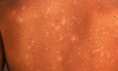 Gutatte hypomelanosis