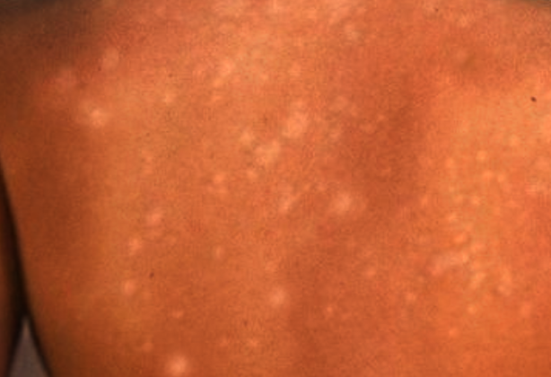 Gutatte hypomelanosis