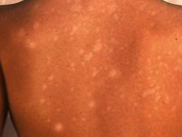 Idiopathic Guttate Hypomelanosis
