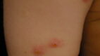 Insect Bites