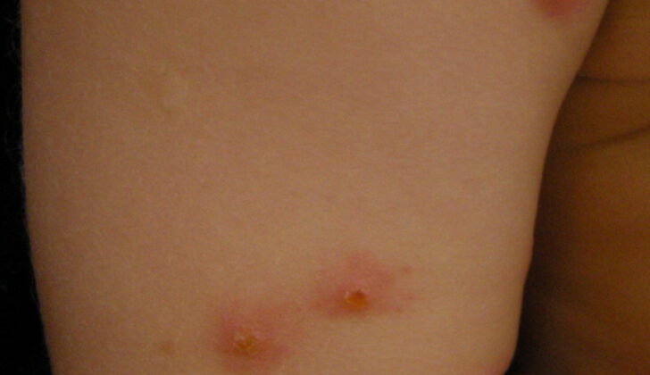 Insect Bites