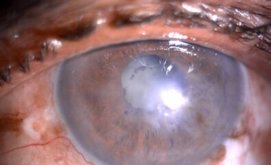Slit- lamp image of the patient with recurrent uveitis depicting mild circumciliary congestion, nebular corneal scarring, few areas of iris atrophy along with a complicated cataract