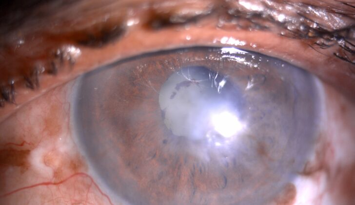 Slit- lamp image of the patient with recurrent uveitis depicting mild circumciliary congestion, nebular corneal scarring, few areas of iris atrophy along with a complicated cataract