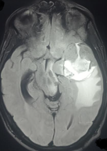 FLAIR MRI sequence in a patient presenting with partial Kluver bucy syndrome due
to herpes encephalitis