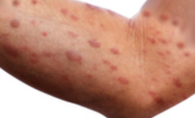 Leukemic cutis