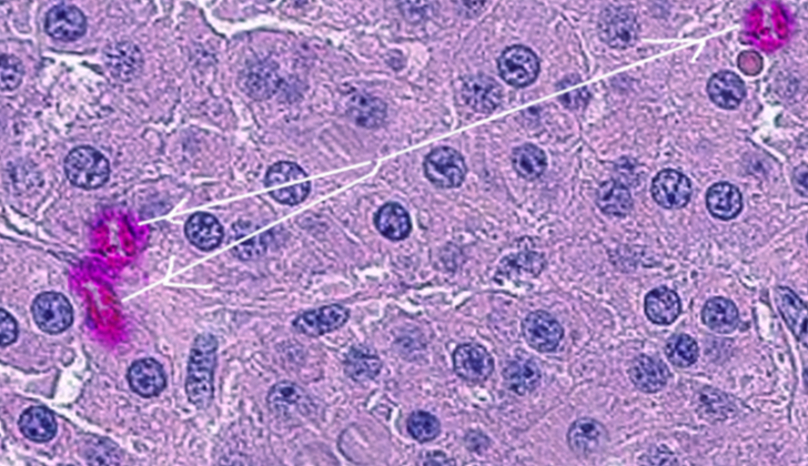 Leydig cell tumor
