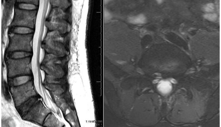 Fig 1. T2 weight MRI of a 67 year old male with L5/S1 disc degeneration and central disc protrusion due to incompetence of the posterior longitudinal ligament and annulus fibrosus of the L5/S1 disc. (A) Sagittal (B) Axial
