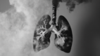 Lung Cancer
