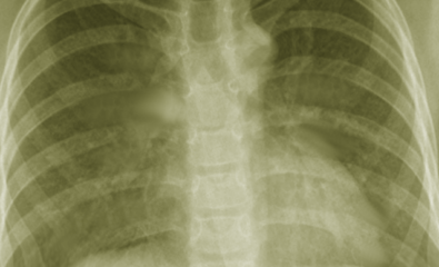Chest X-ray of Mycobacterium Avium-Intracellulare Pneumonia.