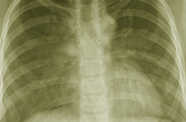 Chest X-ray of Mycobacterium Avium-Intracellulare Pneumonia.