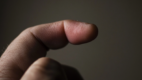 Mallet Finger