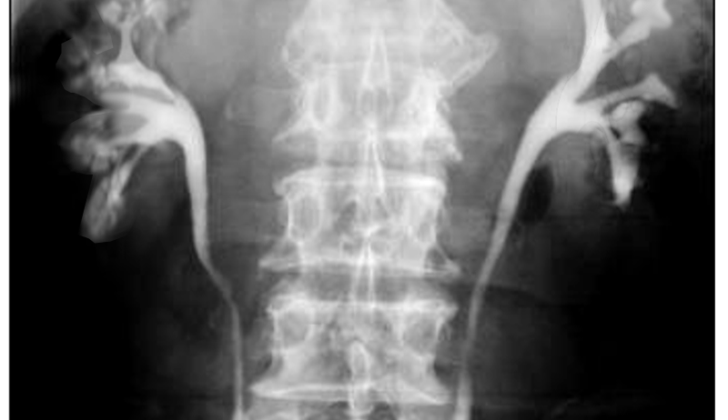 Medullary sponge kidney