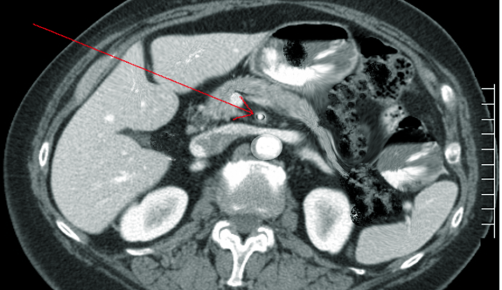 Superior mesenteric artery thrombosis