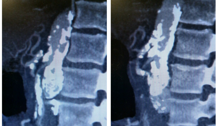 Sagittal view of CT angiogram showing severe atherosclerotic disease of the SMA and celiac artery.