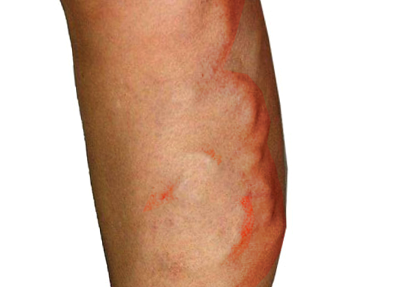Migratory Thrombophlebitis