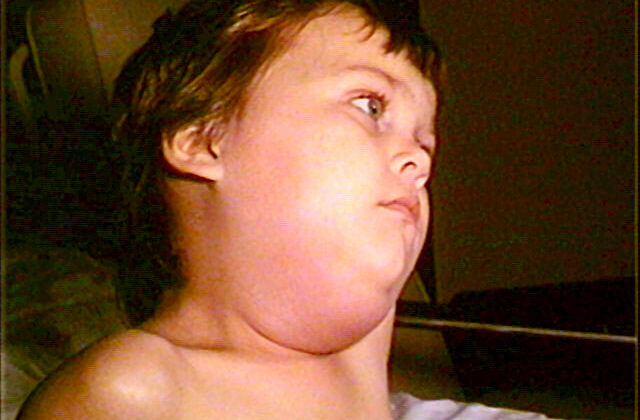 Mumps Parotitis in a Pediatric Patient. Parotid swelling presents as painful inflammation of the area between the earlobe and the angle of the mandible.
