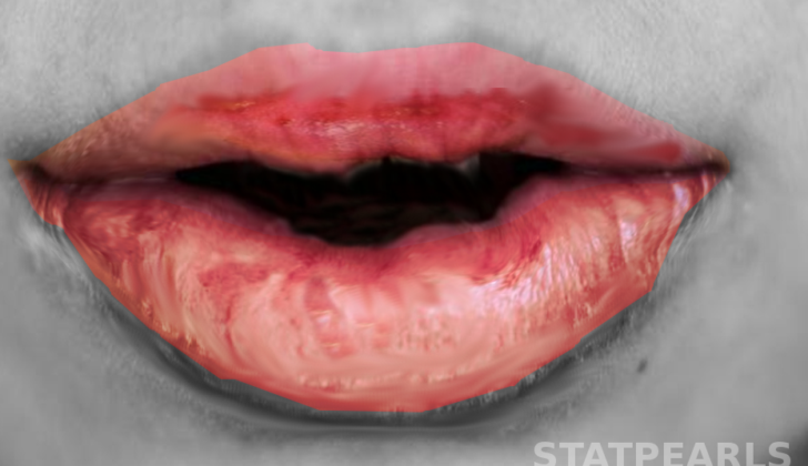 Mycoplasma pneumoniae–Induced Rash and Mucositis (MIRM)