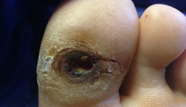 Neuropathic Ulcer. Neuropathic Ulcer beneath the great toe in a patient with diabetes and peripheral neuropathy.