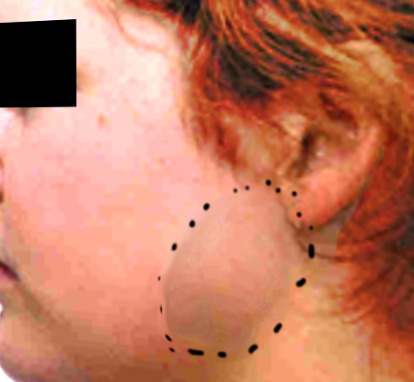 Parotid mass