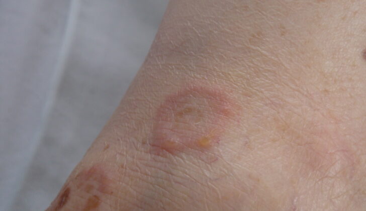 Pemphigus herpetiformis