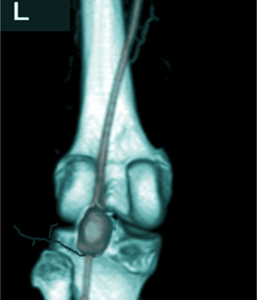 Popliteal Artery Aneurysm Visualized on Magnetic Resonance Angiography. Magnetic resonance angiography visualizes a popliteal artery aneurysm.