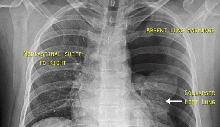 Left-Sided Tension Pneumothorax Radiograph. This image shows a collapsed left lung and mediastinal contents shifting to the right.