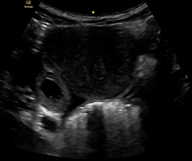 Ectopic Pregnancy, Ultrasound. This image demonstrates an ectopic pregnancy via
ultrasound.