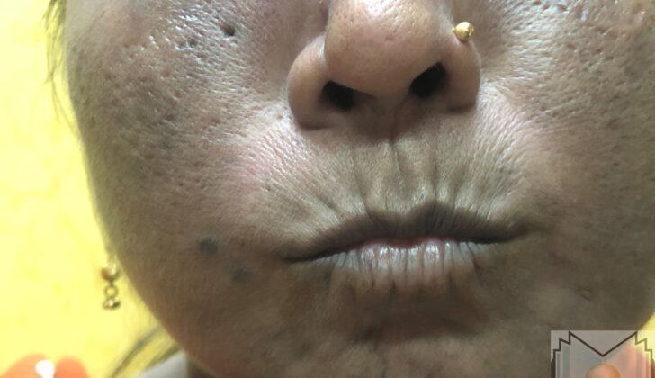Pursed Mouth in a Female Patient With Scleroderma. This image shows a female patient with a pursed mouth, indicative of the cutaneous manifestations of scleroderma.
