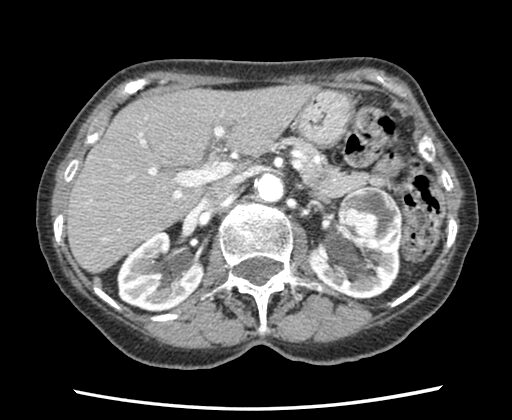 Abdomen CT, Bosniak IV Left Renal Cell Lesion Consistent With Renal Cell Carcinoma