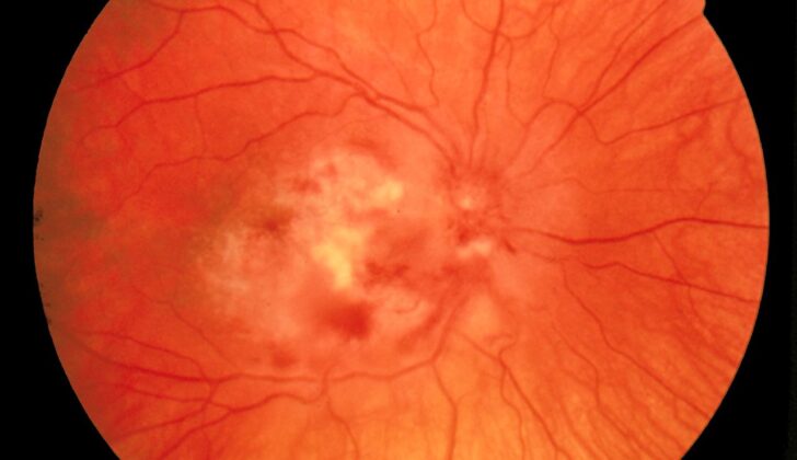 Cytomegalovirus Retinitis. The image depicts a view of a fundus affected by cytomegalovirus retinitis.
