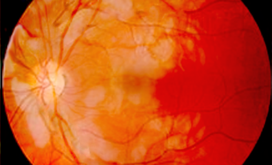 Purtscher Retinopathy