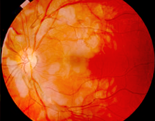 Purtscher Retinopathy