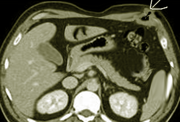 Richter hernia following laparoscopy