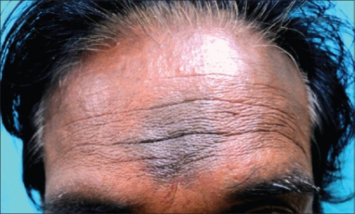 Riehl Melanosis