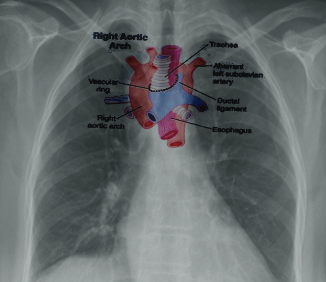 Right Aortic Arch