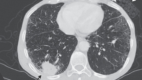 Squamous Cell Carcinoma of the Lung. Chest CT image of squamous cell carcinoma.