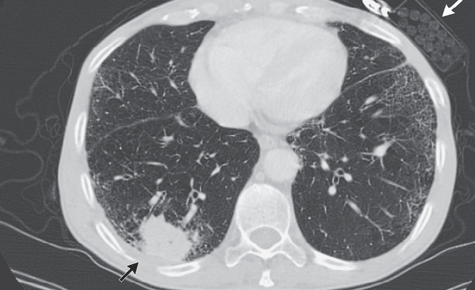 Squamous Cell Carcinoma of the Lung. Chest CT image of squamous cell carcinoma.