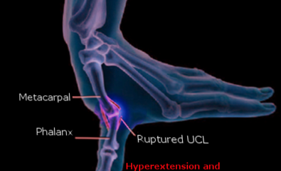 Rupture of the UCL of thumb